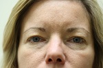  Patient Before Eyelid Surgery